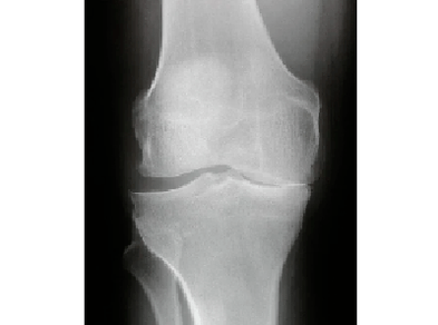 Diagnosis of arthrosis of the knee joint