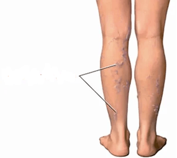 The consequences of the illegal knee