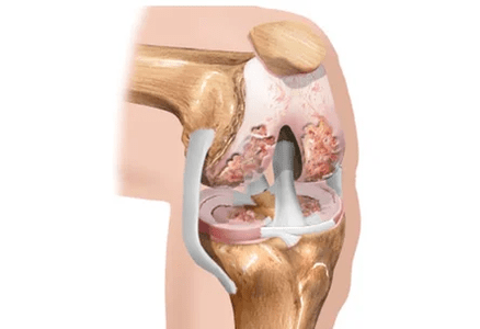 arthrosis or arthritis of the differences