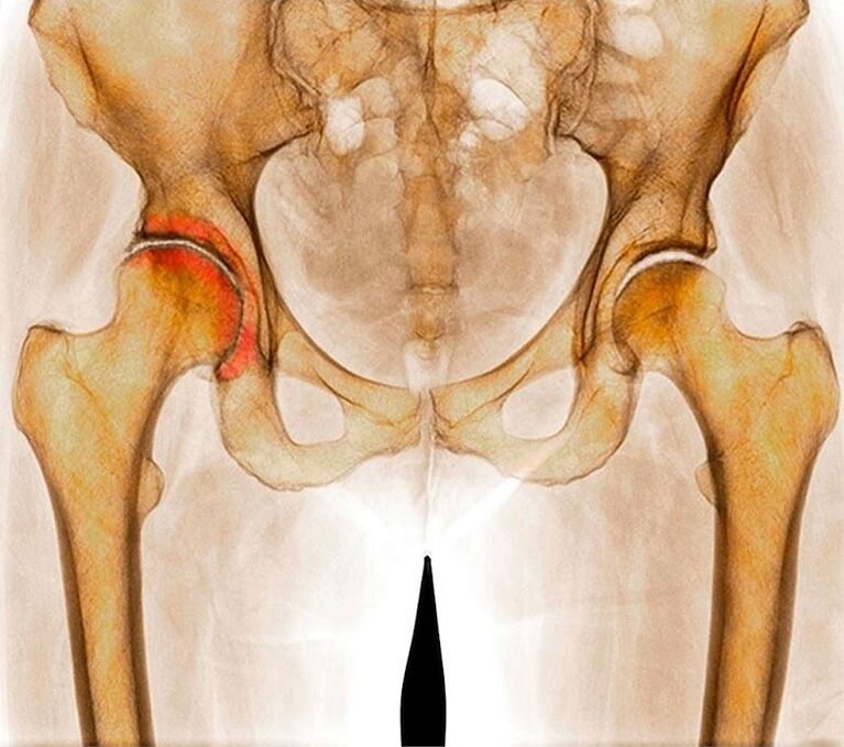 Arthrosis of the hip joint