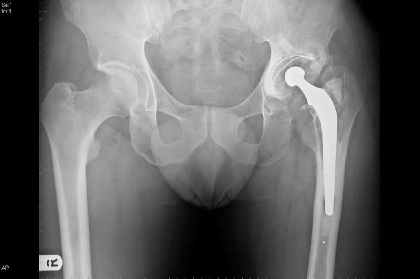 Coksartrosis