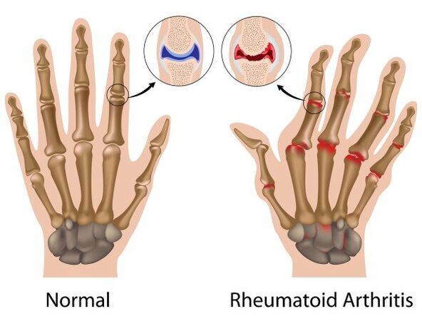 Dita joints without pathology and with rheumatoid arthritis