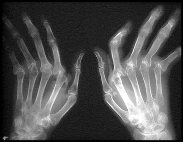 Quad -racing hands affected by osteoarthritis