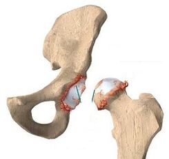 The reasons for the development of arthrosis of the hip joint