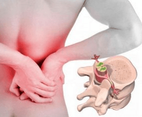 Lumbago at the beginning of osteochondous disease