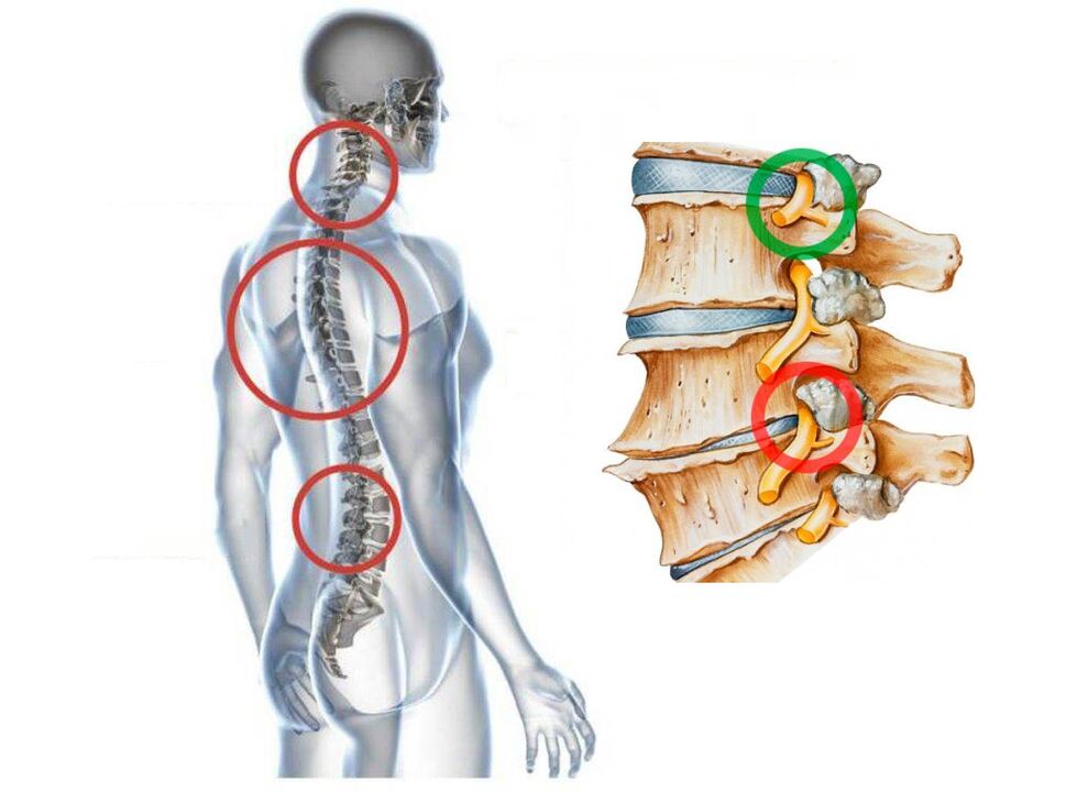 How the cervical osteochondosis of the vertebrae appears