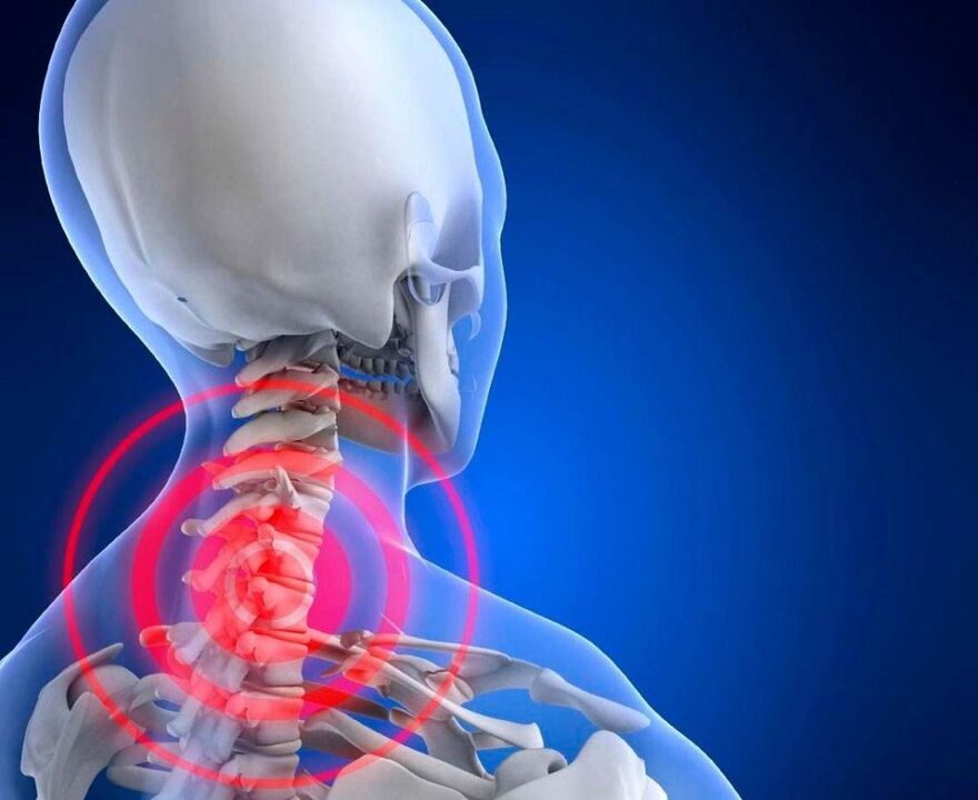 Neck pain with cervical osteochondosis