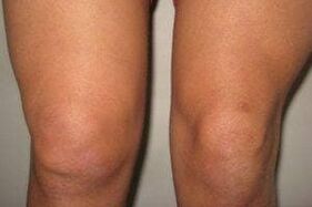 inflammation of the knee joint with arthritis and arthrosis