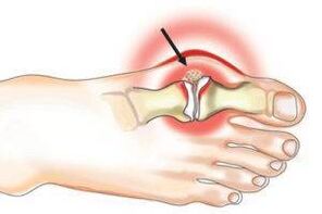 joint damage due to arthritis and osteoarthritis
