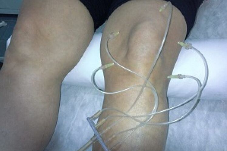 Ozone therapy