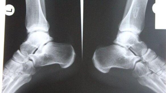 Diagnosis of ankle arthritis by radiography