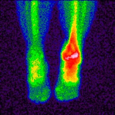 The method of differential diagnosis of crociarthrosis is scintigraphy